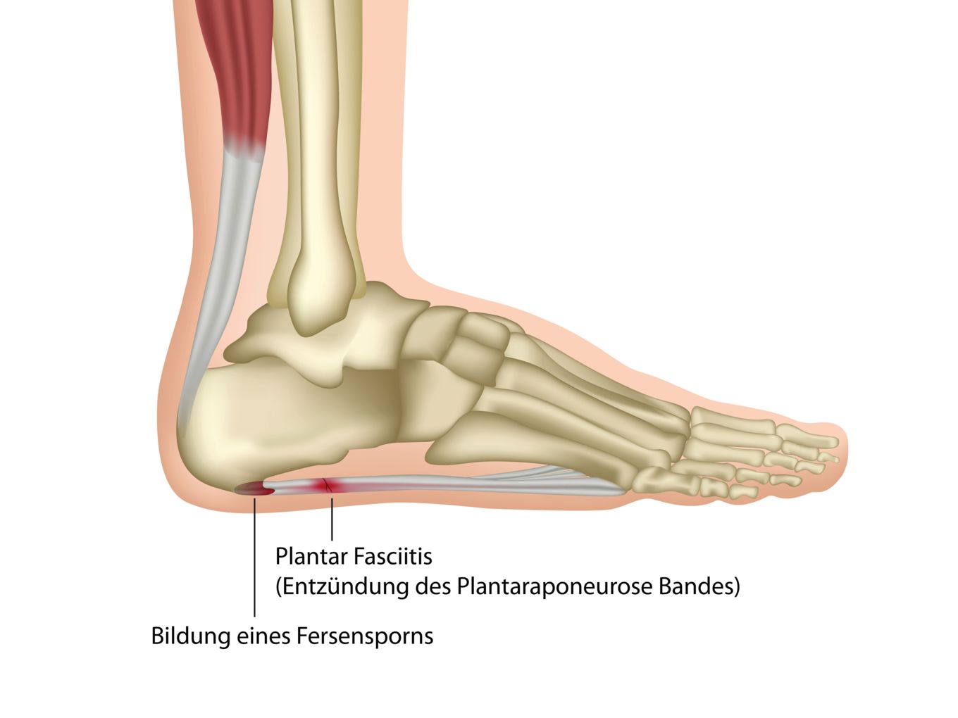 So verursacht ein Fersensporn Schmerzen unter dem Fuß